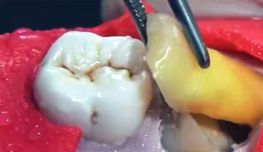鲅鱼圈拔智齿