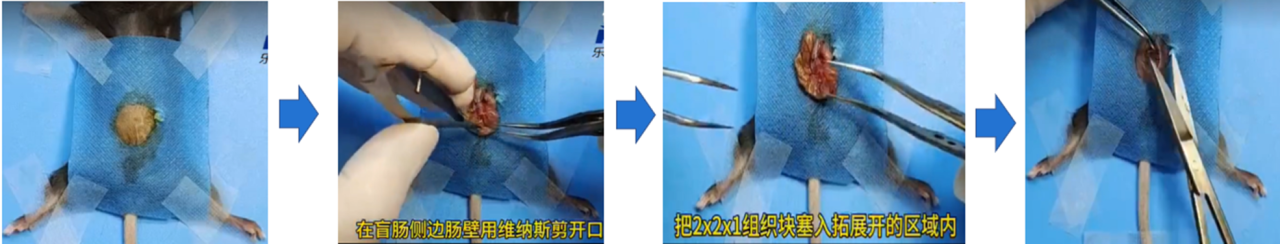 结直肠癌