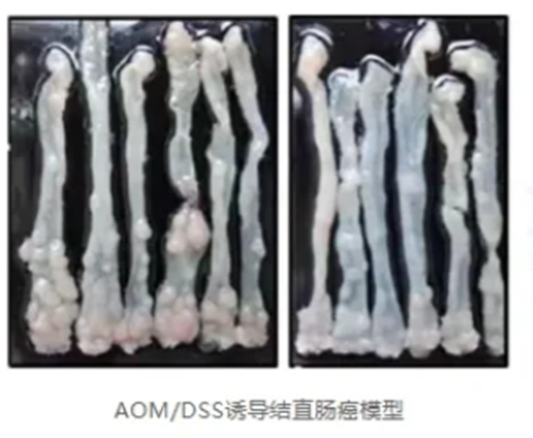 结直肠癌