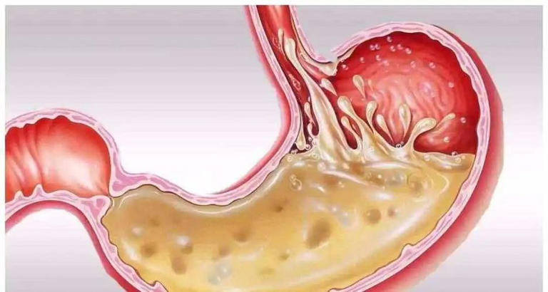 1765265637816704.jpg 胃癌